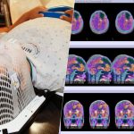 Nueva esperanza para prolongar la vida de los pacientes con el cáncer cerebral más agresivo: los glioblastomas