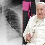 Papa Francisco: Neumonía Bilateral y Reposo Absoluto