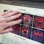 «De la Montaña al Laboratorio: HypoxyStat y el Síndrome de Leigh»