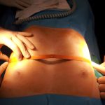 Innovación en el tratamiento del pecho hundido: Prótesis personalizadas