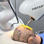 La Revolución de la Inteligencia Artificial en el Tratamiento de la Alopecia