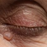 «Verrugas en los párpados: Mitos, realidades y tratamientos efectivos»