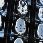 «Investigadores descubren que la geometría del cerebro puede predecir el riesgo de Alzheimer años antes de los síntomas»