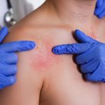 Sarampión en Norteamérica: México lidera el brote mientras la región enfrenta una crisis sanitaria sin precedentes