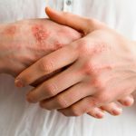 «Guía completa para prevenir la dermatitis atópica: De la higiene a la alimentación»