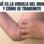 «Viruela Símica en República Dominicana: Autoridades Garantizan Control y Explican Medidas de Prevención»